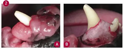 Gingival Hyperplasia