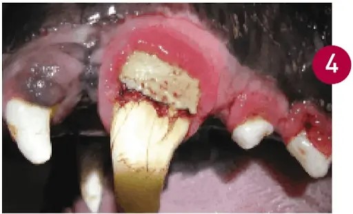 Gingival Hyperplasia